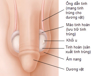 triệu chứng ung thư tinh hoàn