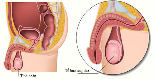 Nguyên nhân gây bệnh ung thư tinh hoàn