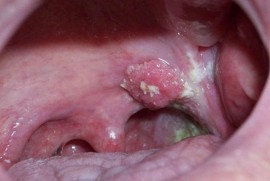 Ung thư vòm họng nguy hiểm như thế nào?