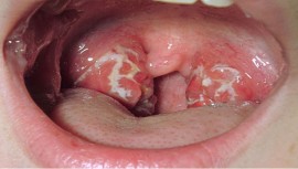 Biểu hiện giai đoạn đầu của bệnh ung thư vòm họng