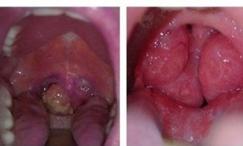 Bị bệnh Ung thư vòm họng thì sống được bao lâu?