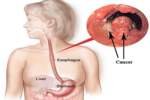 Những thực phẩm tốt cho bệnh nhân Ung Thư Thực Quản