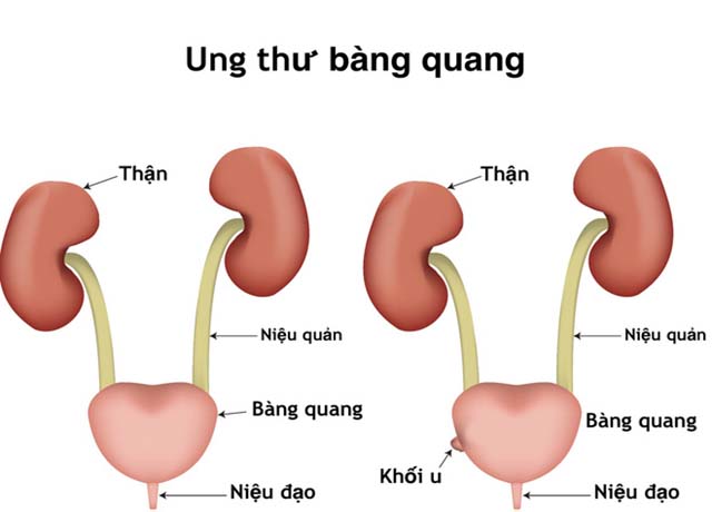 Dấu hiệu ung thư bàng quang ở nam giới