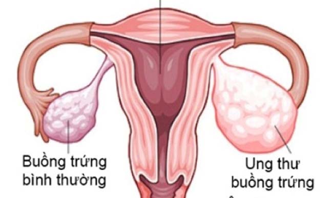 Dấu hiệu cảnh báo sớm ung thư buồng trứng