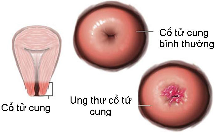 Nguyên nhân và triệu chứng bệnh Ung thư cổ tử cung