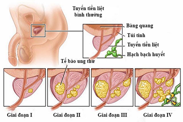 Dấu hiệu cảnh báo bạn bị ung thư tuyến tiền liệt