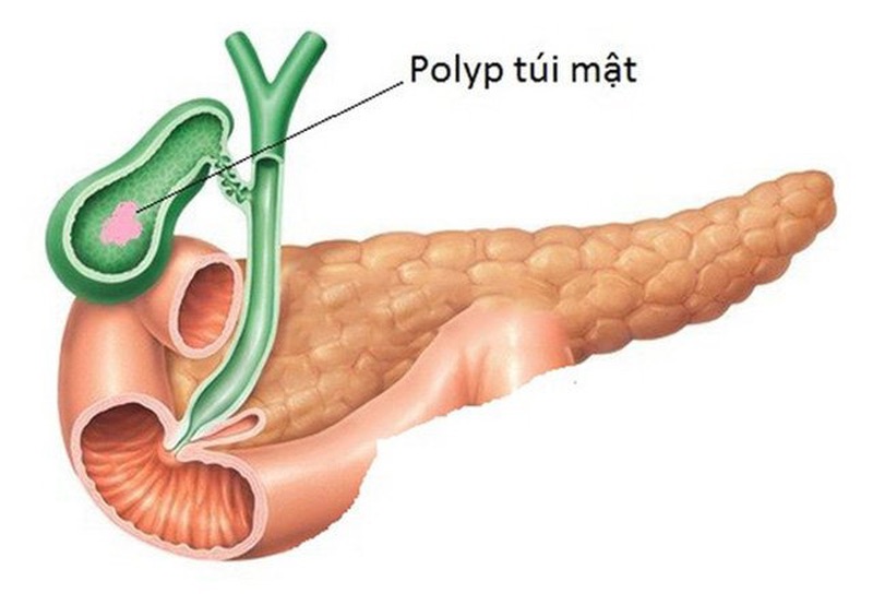 Hình ảnh mô tả polyp túi mật