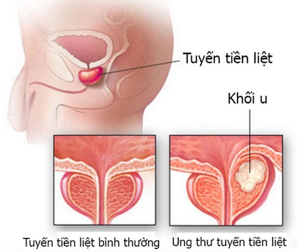 Ung thư tuyến tiền liệt hay còn gọi là ung thư tiền liệt tuyến là một dạng của ung thư phát triển trong tuyến tiền liệt, một tuyến trong hệ sinh dục nam. Ung thư tuyến tiền liệt phát triển chậm, tuy nhiên, có những trường hợp ung thư di căn.[1] Các tế bào ung thư có thể di căn (lan) từ tuyến tiền liệt sang các bộ phận khác của cơ thể, đặc biệt là vào xương và các hạch bạch huyết. Ung thư tuyến tiền liệt có thể gây đau đớn và khó khăn trong việc đi tiểu, quan hệ tình dục gặp vấn đề, hoặc rối loạn chức năng cương dương. Các triệu chứng khác có khả năng phát triển trong giai đoạn sau của bệnh.