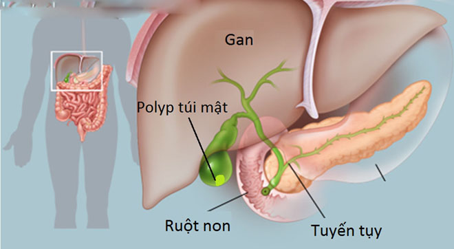 Gallbladder polyps