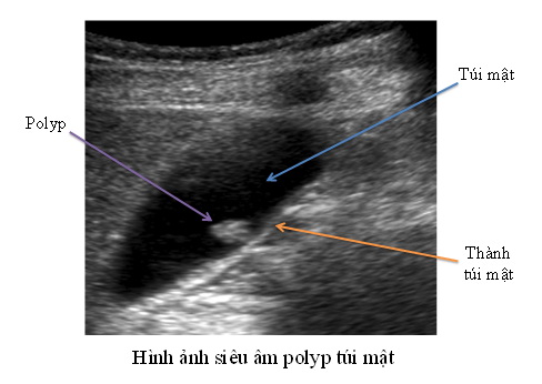 Polyp túi mật: Sự lo lắng khả năng ung thư hoá