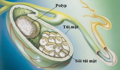 Sỏi túi mật