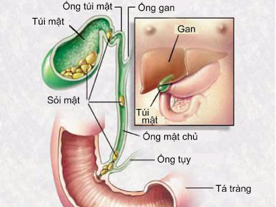 Sỏi mật