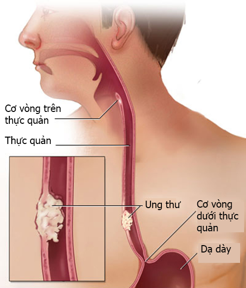 Ung thư thực quản